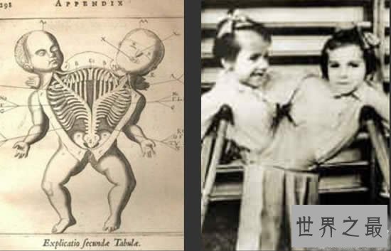 史上最骇人听闻的10个人体试验,人造连体婴儿最残忍