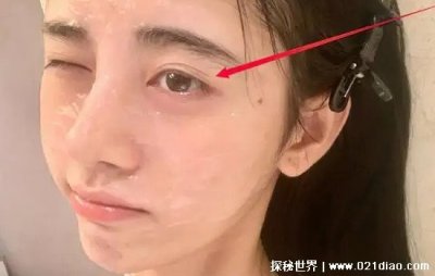 ​世界上眼皮最多的人，最多的有五眼皮(眼周皮肤松弛造成)