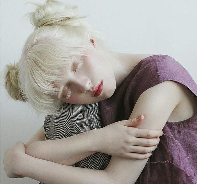 全球最美模特！上帝给了她残疾，却成就了她令人心碎的美貌