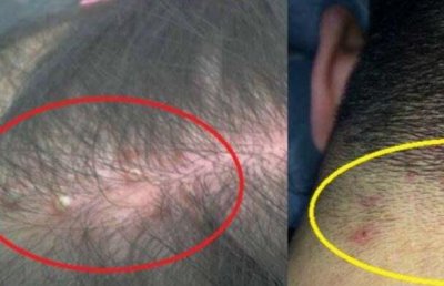 ​头上长疙瘩是什么缘故 头上为什么会长疙瘩