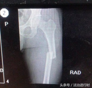 ​V早报：北京昌平90后刑警为追捕盗窃嫌犯大腿骨折