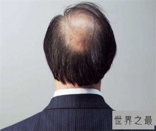 掉头发是什么原因 女生头发稀少应该怎么办