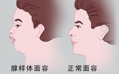 ​影响孩子颜值的“腺样体面容”该怎么判断？专家教你3种方法