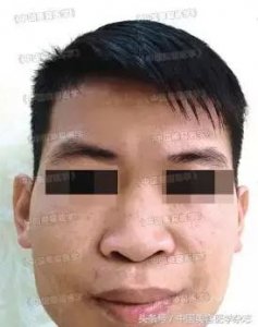 ​经常被忽视的病症，其实从小就改变你的相貌——Binder综合征