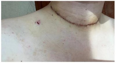 ​大家做了甲状腺手术后，有后悔的吗？