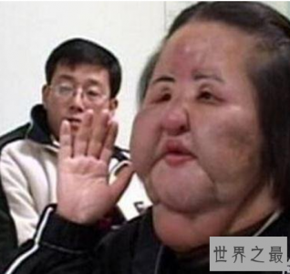 ​世界十大整容失败案例，最疯狂的是取出66克的硅胶？