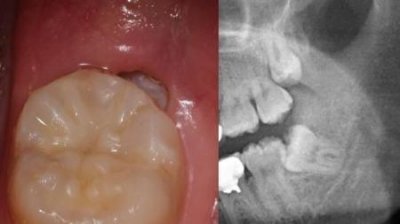 ​智齿发炎疼痛难忍怎么办(智齿发炎痛的厉害怎么办)