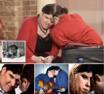 ​世界上最年长连体双胞胎在美国同日去世，享年62岁，共享大脑