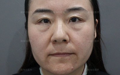 ​42岁“豁出去”做了眼袋手术，15天恢复期，术后实拍图来了